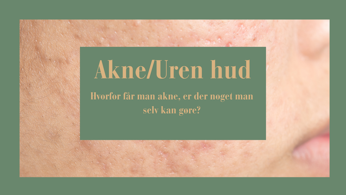 Hvorfor får man uren hud?