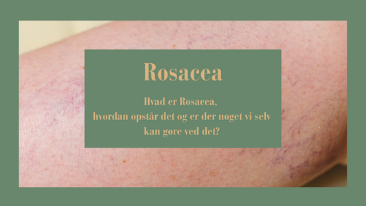 Hvad er Rosacea (rødme)